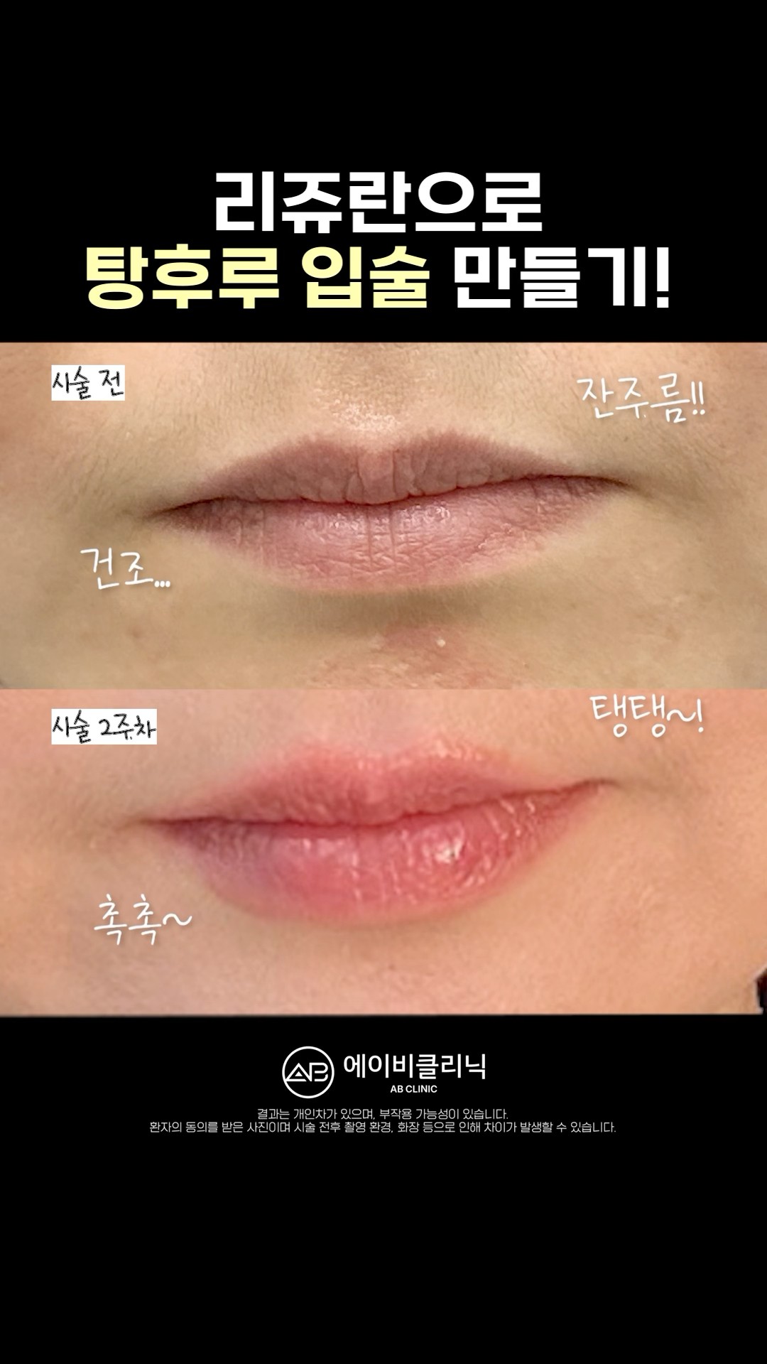 립 플럼퍼 없이 탕후루 입술 만드는 법💋