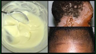 2 EASY STEPS TO GET RID OF SCALP PSORIASIS NATURALLY | FOR  MILD  TO SEVERE  |Khichi Beauty