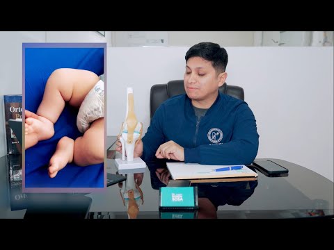 📍Las hemimelias (ausencia de huesos) son un verdadero reto. - Dr. Rubén Sosa