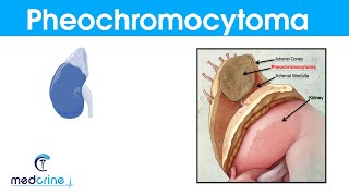 Pheochromocytoma causes,pathophysiology,symptoms and treatment
