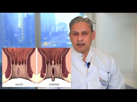 Painful Anal Fissure - The 15 seconds treatment