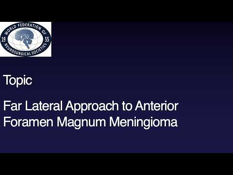 Left Far Lateral Approach for Foramen Magnum Meningioma