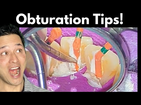 Root Canal Obturation Simplified 