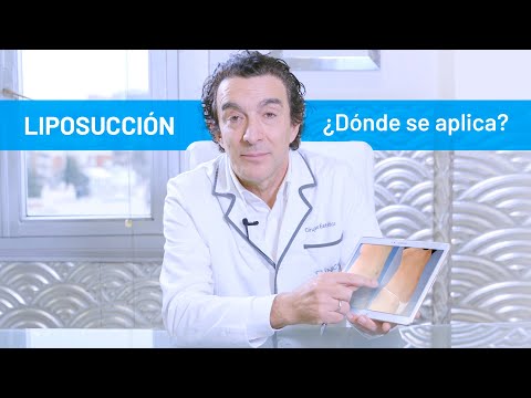 Qué es la Liposucción y Cómo se Aplica