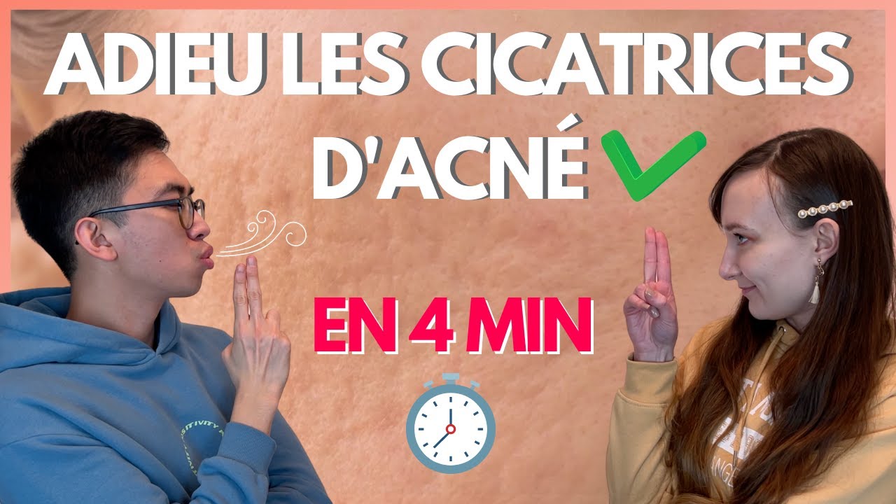 En finir avec les cicatrices d’acne? (en 4 minutes) !