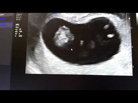 Ecografía 9 semanas