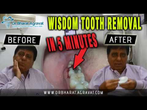 Wisdom Tooth Removal Surgery By Smile In Hour Dentist Dental Clinic India