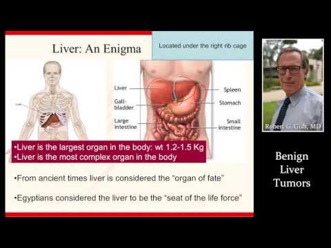 BENIGN (NON-CANCEROUS) LIVER TUMORS by Dr. Robert Gish