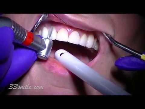 YouTube video about: How often do you have to replace veneers?