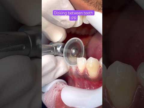 IPR BRACES, Orthodontics Treatment