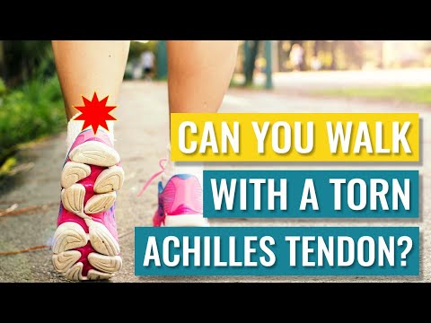 Can You Walk on a Torn Achilles Tendon? Partial / Full Ruptures