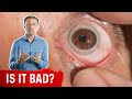 Why the White Ring Around Your Iris?