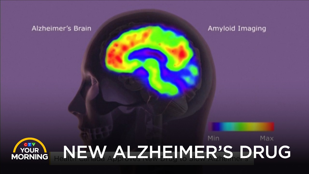 Health Canada Approves New Alzheimer’s Drug: What is Donanemab? | Your Morning