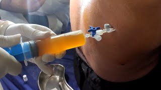 Remove 1000cc fluid from the lung | Therapeutic Thoracentesis