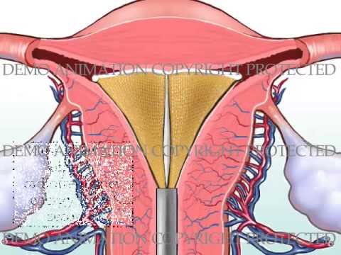 endometrium abláció és fogyás