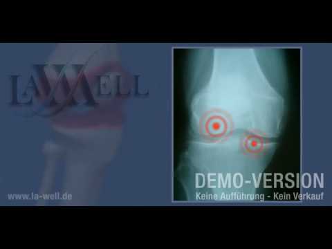 Schmerzen im Gelenkbereich der Großzehe Darsonval in Osteochondrose der Halswirbelsäule zu behandeln
