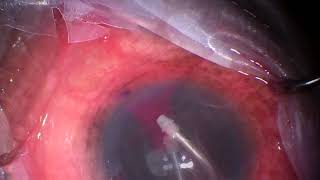 Download Lagu CyPass trimming turned explant/removal Thumbnail