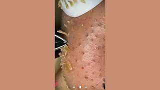 Download lagu Skincare | Blackheads Removal #625 #tweezers skincare #blackheads blackheads mp3