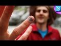 Smashed Fingernail Blood Draining DIY Surgery
