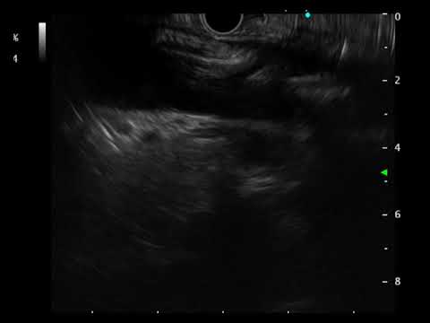 Video 17 Scanning Superior Mesenteric Artery from Duodenum