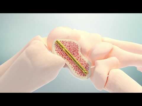 OsteoCentric Technologies Headless Compression System