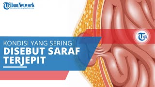 Hernia Nukleus Pulposus, Kondisi yang Sering Disebut oleh Orang Awam sebagai Saraf Terjepit
