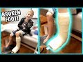 Getting a Cast! Jacob Broke His Foot - Part 2