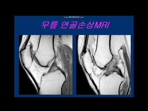 무릎 연골손상MRI