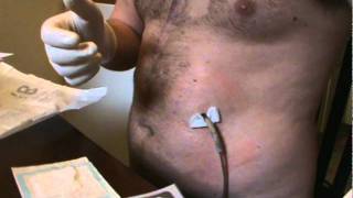 LVAD Dressing Change