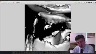 3D Surface vs Volume