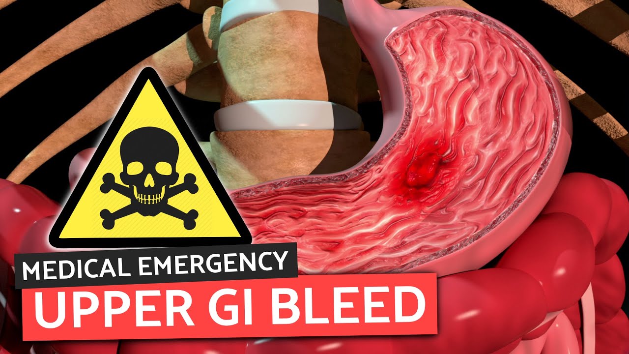 Upper GI Bleeds for Medical/PA Finals | Medical Emergencies Made Easy