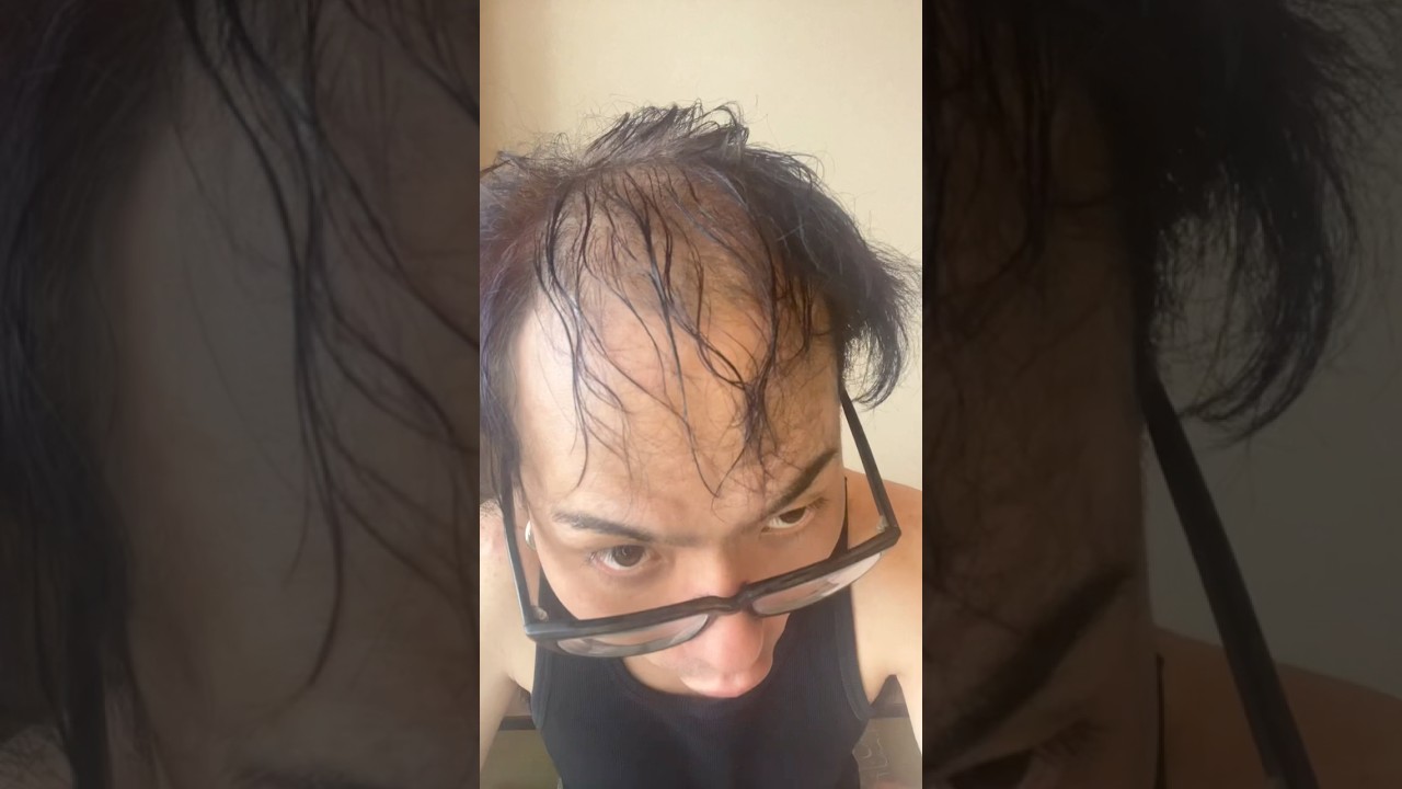 若ハゲが本気の大変身‼︎#ハゲ#薄毛#髪の毛#コンプレックス