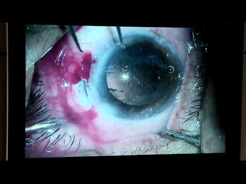 Cataract removal in China