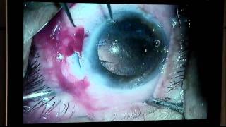 Cataract removal in China