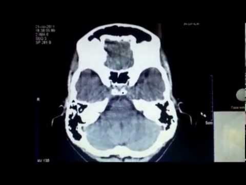Descomplicando uma TC de crânio (multi slice)