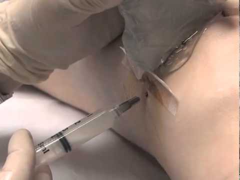 Ultrasound Guided Knee Injection Technique - How To