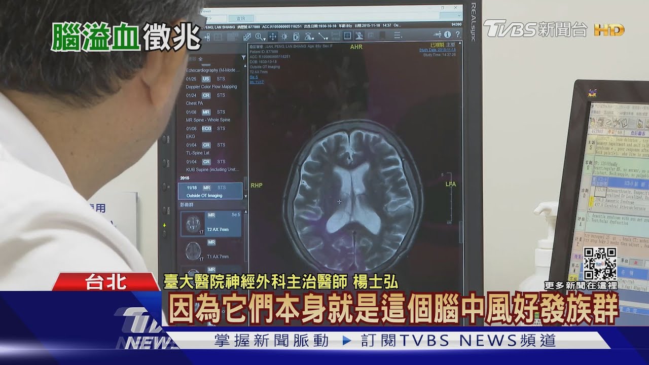 有片/不注意這幾件事導致「腦溢血」 醫師:致死風險高!