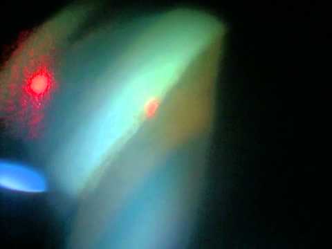 SLT Clinical Footage: Narrow Angle Glaucoma