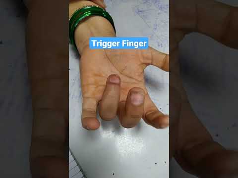 Trigger Finger #doctor #orthopaedic