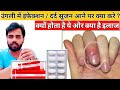 ऊँगली में सूजन दर्द लाल होने के क्या क�