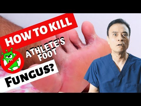 How to kill athlete's foot fungus?