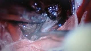 Download Lagu SOL Cerebellum in 4 years old children. Agung Budi Sutiono, MD, PhD Thumbnail