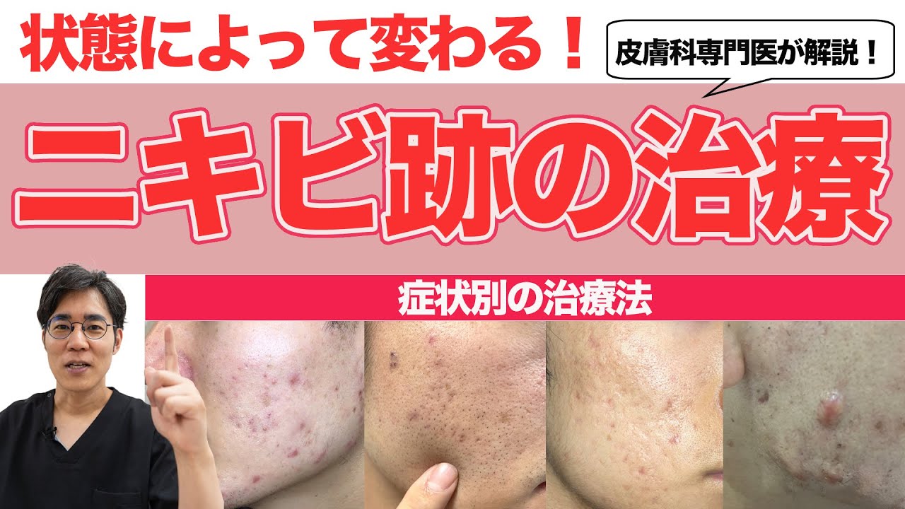 【ニキビ跡治療法】赤色、茶色、凸凹、状態によって変わるニキビ跡の治療