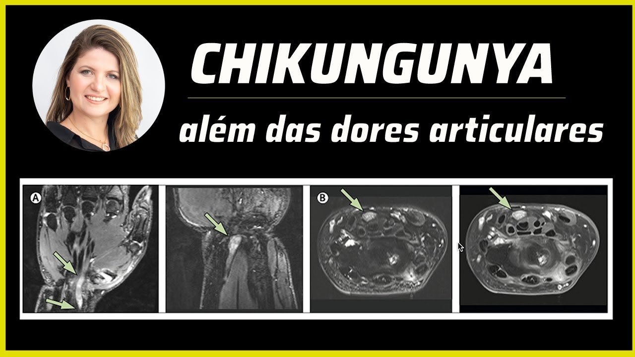 CHIKUNGUNYA : ALÉM DAS DORES ARTICULARES