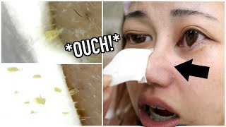 watch me cry while peeling off &quot;blackheads&quot;