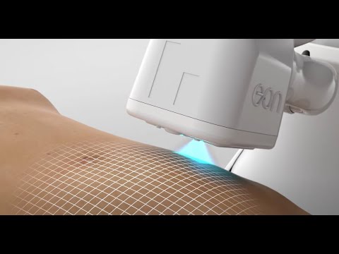 Laser liposuction technology - EON robotic body contouring - 3D animation