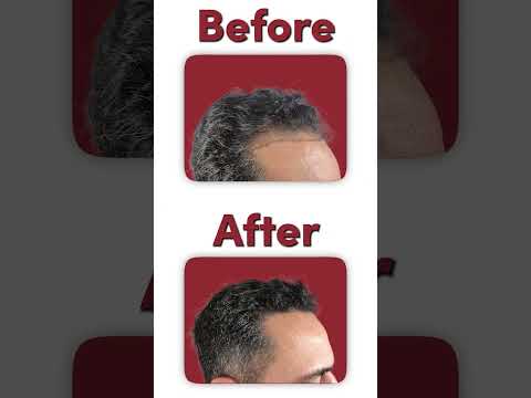 Life-Changing Hair Transplant in Istanbul, Turkey: Detailed Before and After Result Breakdown