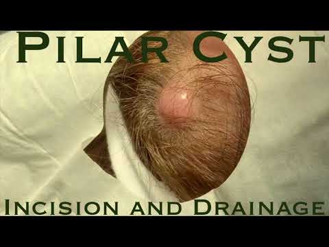 Huge Pilar Cyst Incision and Drainage