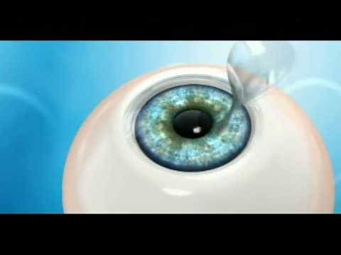 Medical Minute: LASIK Overview