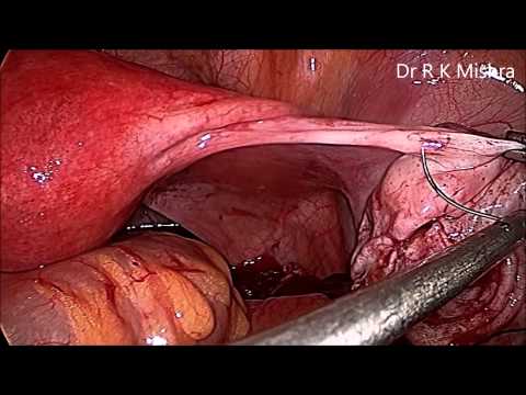 Management of Recurrent Ovarian Torsion by Laparoscopic Oophoropexy
